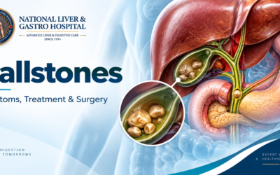 Gallstones: Symptoms, Causes, Treatment Options and When Surgery May Be Needed in Guntur
