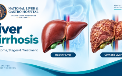 Cirrhosis of the Liver: Stages, Symptoms, Causes and Treatment Options in Guntur